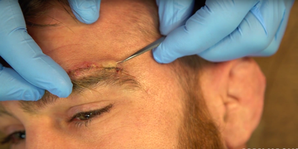 A Green Beret Demonstrates How To Remove Your Own Stitches
