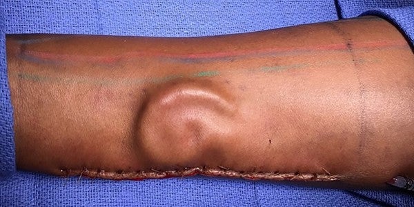 A Soldier Is Getting A New Ear… Once It Finishes Growing In Her Arm
