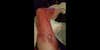 Navy Vet Sues Over E-Cig That Blew This Hole In His Leg (Graphic)