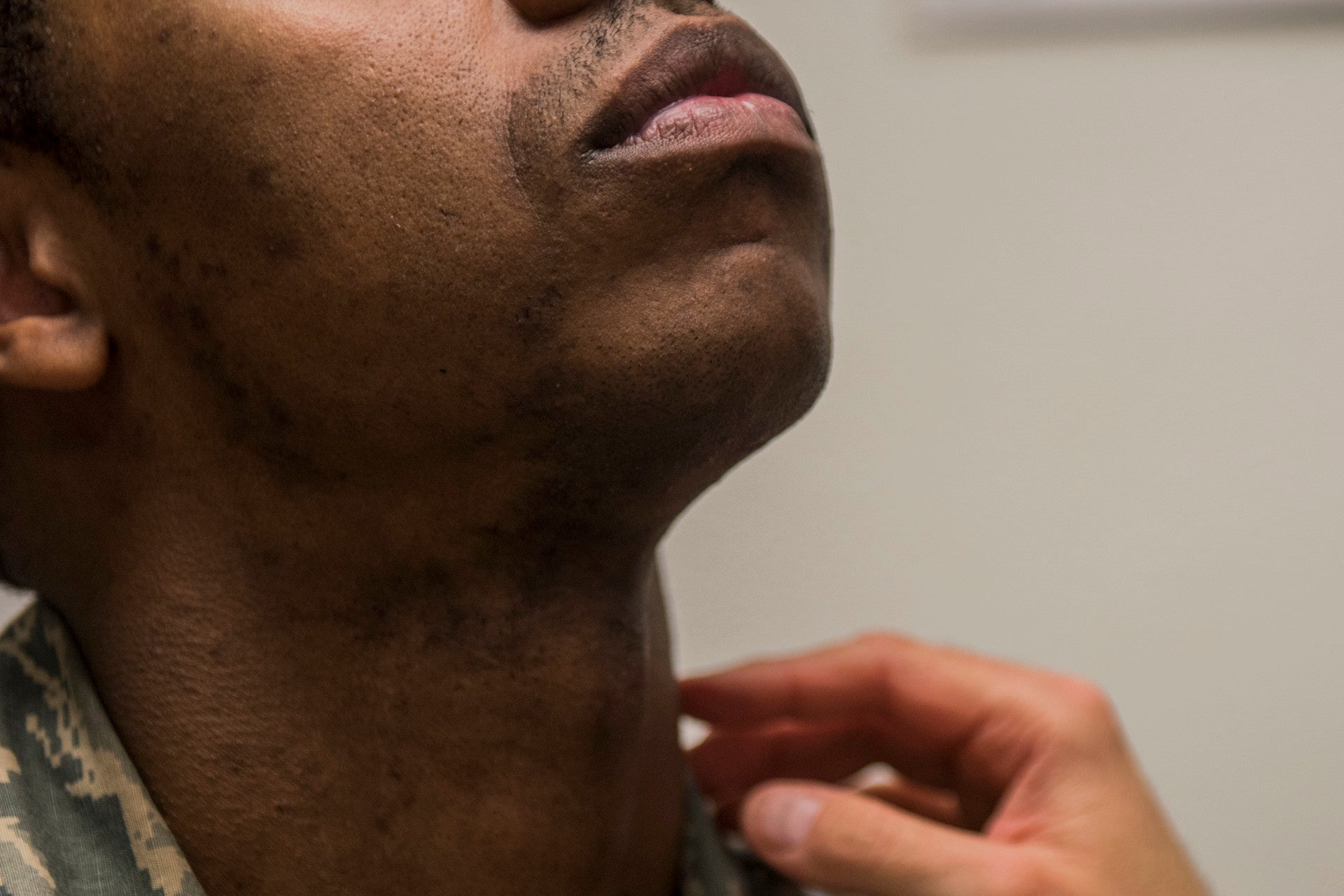 Staff Sgt. Antoine, 13th Intelligence Squadron intelligence analyst, raises his head as Lt. Col. David Gregory, 9th Medical Group flight surgeon chief of medical staff, inspects his neck and face during a shaving waiver course at Beale Air Force Base, California, March 15, 2018. The most common reason Airmen request shaving waivers is due to pseudofolliculitis barbae, or PFB, which is also known as shaving bumps or ingrown hairs.