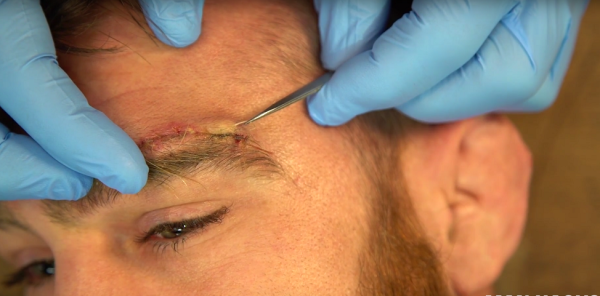 A Green Beret Demonstrates How To Remove Your Own Stitches